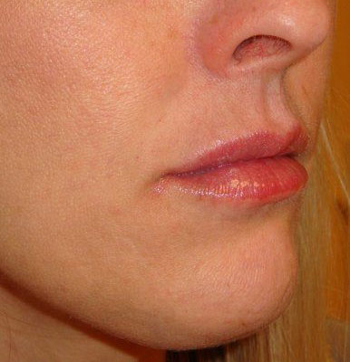 Botox & Fillers Before And After Patient 8