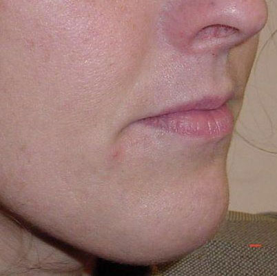 Botox & Fillers Before And After Photo