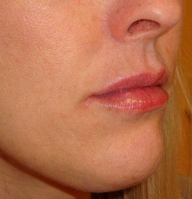 Botox & Fillers Before And After Photo