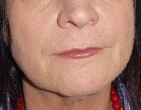 Botox & Fillers Before And After Patient 11