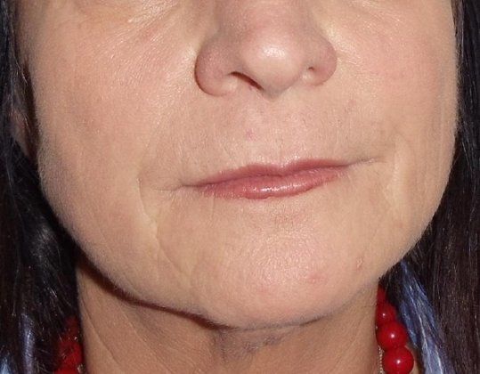 Botox & Fillers Before And After Patient 12