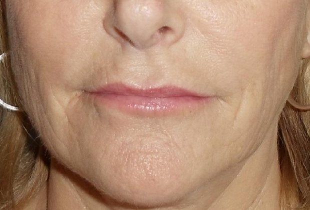 Botox & Fillers Before And After Patient 13