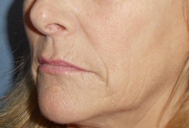 Botox & Fillers Before And After Photo