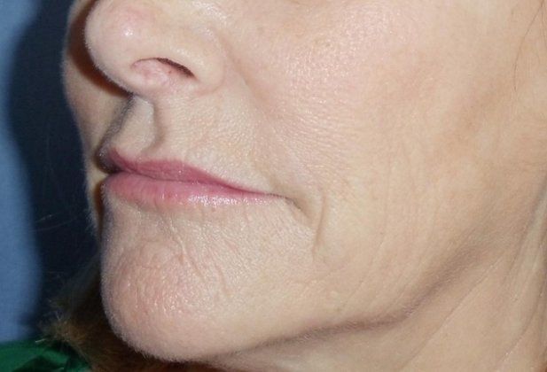 Botox & Fillers Before And After Photo