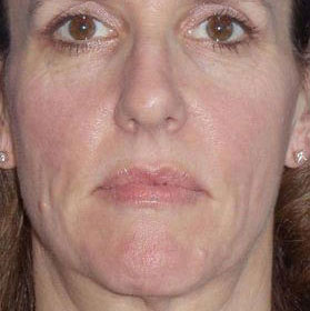 Botox & Fillers Before And After Photo