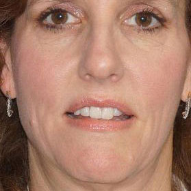 Botox & Fillers Before & After Image