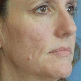 Botox & Fillers Before And After Photo