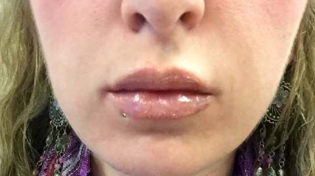 Botox & Fillers Before And After Patient 16