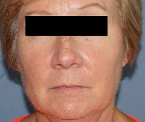 Botox & Fillers Before And After Patient 17