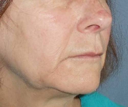 Botox & Fillers Before And After Patient 17