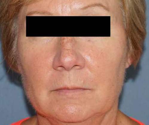 Botox & Fillers Before And After Patient 18