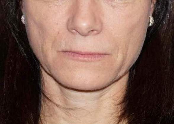 Botox & Fillers Before And After Photo