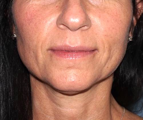 Botox & Fillers Before And After Patient 20