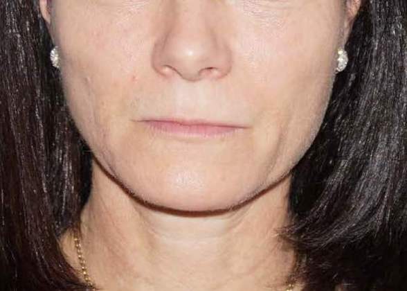 Botox & Fillers Before And After Photo