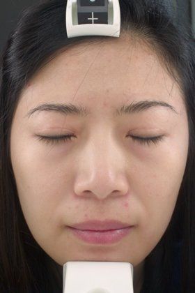 Chemical Peels Before And After Photo