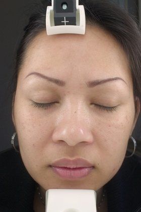 Chemical Peels Before And After Photo