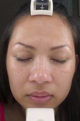 Chemical Peels  Before And After Patient 2