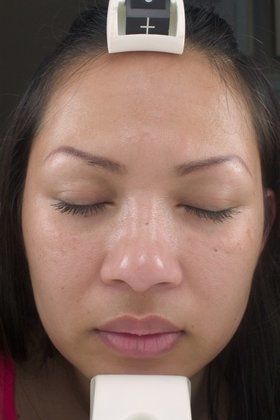 Chemical Peels Before And After Photo