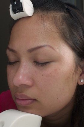 Chemical Peels Before And After Photo