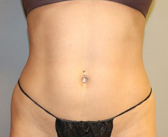 CoolSculpting Before & After Image