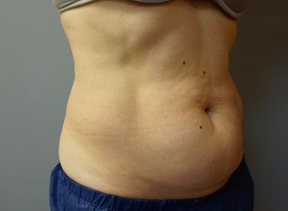 Coolsculpting Before And After Photo