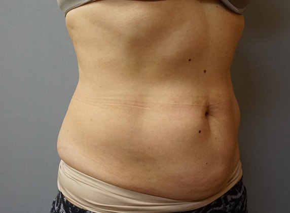 Coolsculpting Before And After Photo