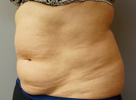 Coolsculpting Before And After Photo