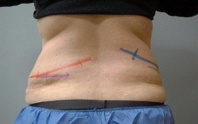 Coolsculpting Before And After Photo