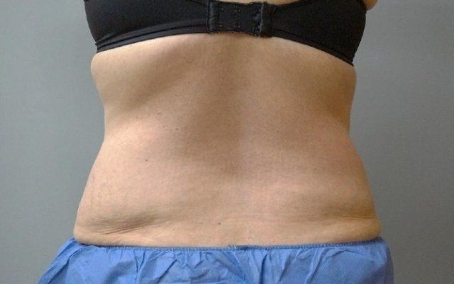 Coolsculpting Before And After Photo