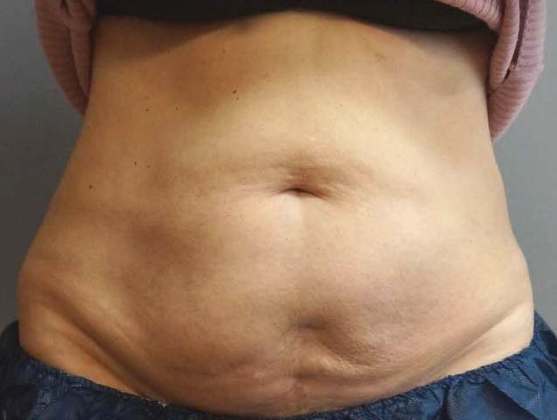 Coolsculpting Before And After Photo