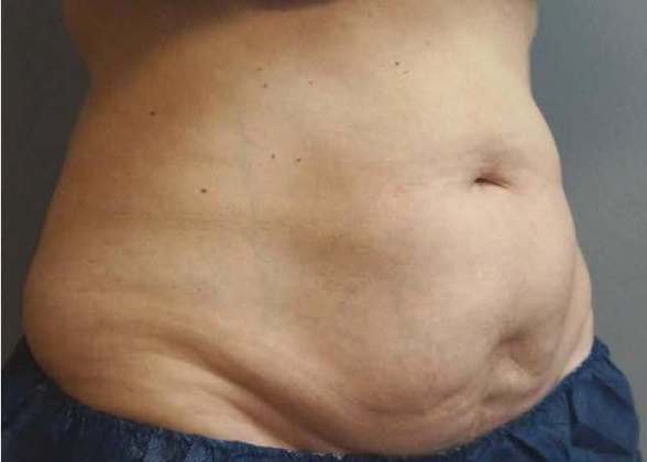 Coolsculpting Before And After Photo