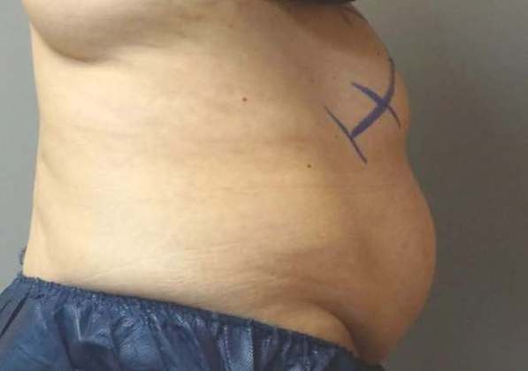 Coolsculpting Before And After Photo