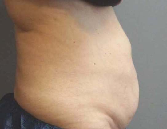 Coolsculpting Before And After Photo