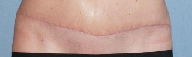 Fractional Laser Treatment Before And After Photo