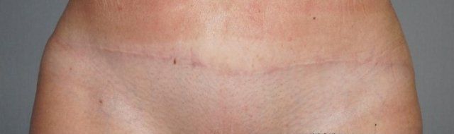 Fractional Laser Treatment Before And After Patient 1