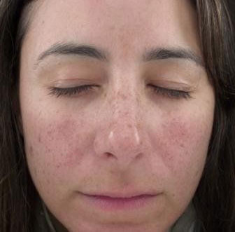 IPL Photofacial Before And After Photo