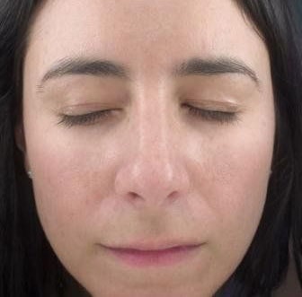 IPL Photofacial Before And After Patient 1