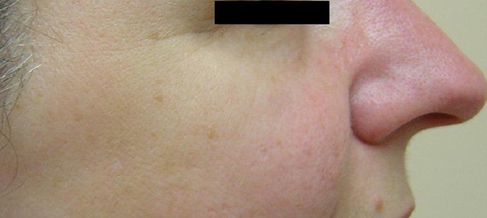 IPL Photofacial Before And After Patient 2