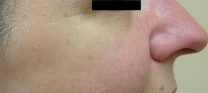 IPL Photofacial Before And After Photo