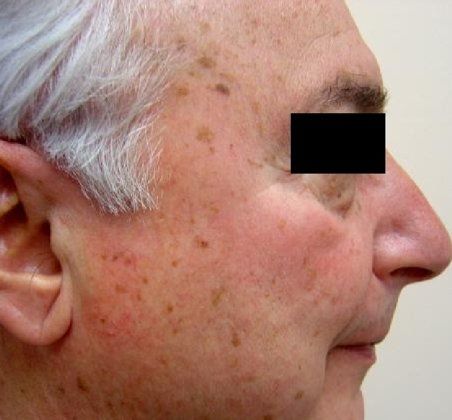 IPL Photofacial Before And After Photo