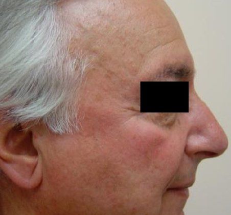 IPL Photofacial Before And After Photo