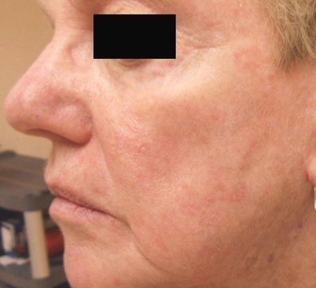 IPL Photofacial Before And After Patient 5