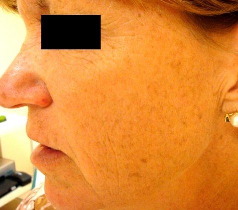 IPL Photofacial Before And After Photo