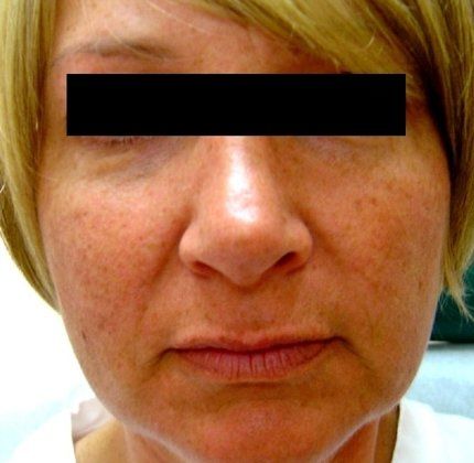 IPL Photofacial Before And After Photo