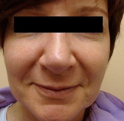 IPL Photofacial Before And After Patient 8