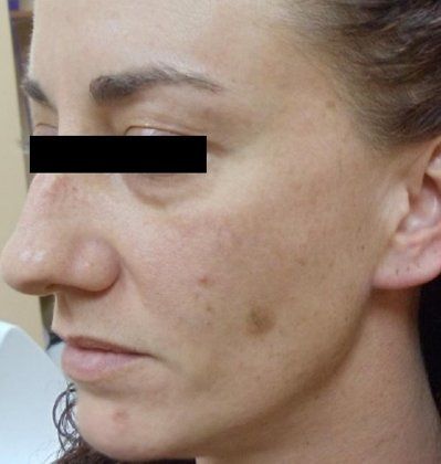 IPL Photofacial Before And After Photo