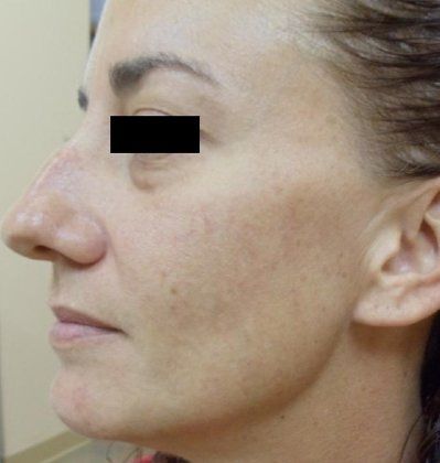 IPL Photofacial Before And After Patient 10