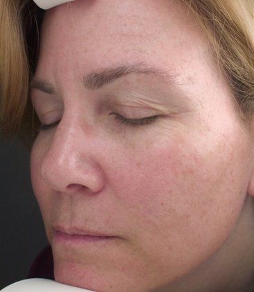 IPL Photofacial Before And After Photo
