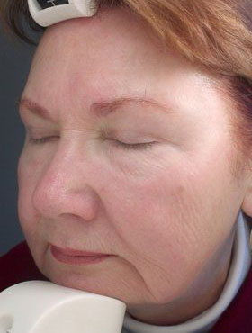 IPL Photofacial Before & After Image