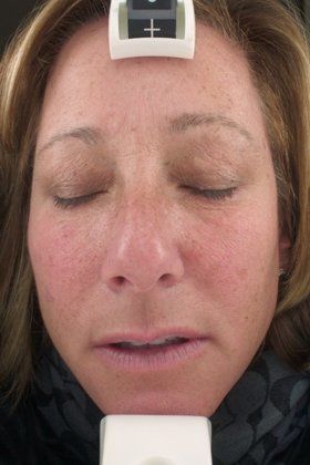 IPL Photofacial Before & After Image